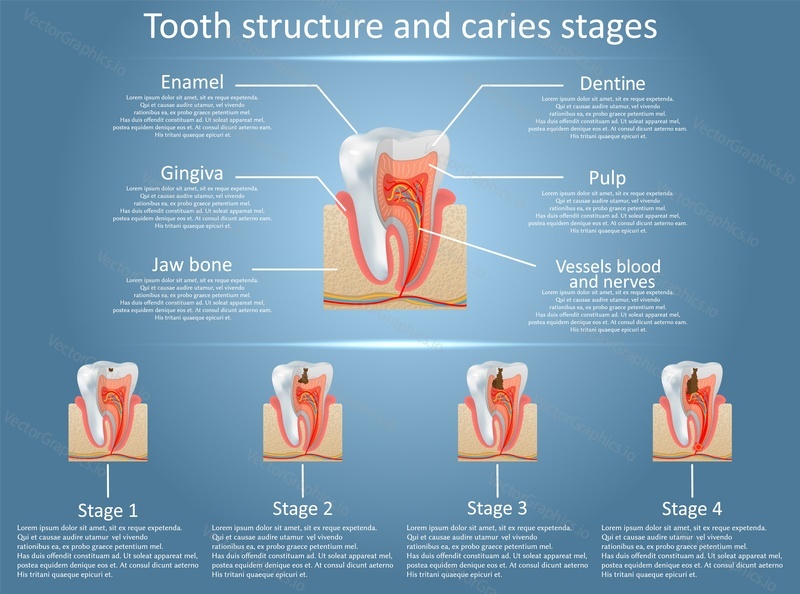 Human tooth structure vector diagram and caries stages. Dental anatomy and tooth decay or cavities development concept. Training medical anatomical poster.
