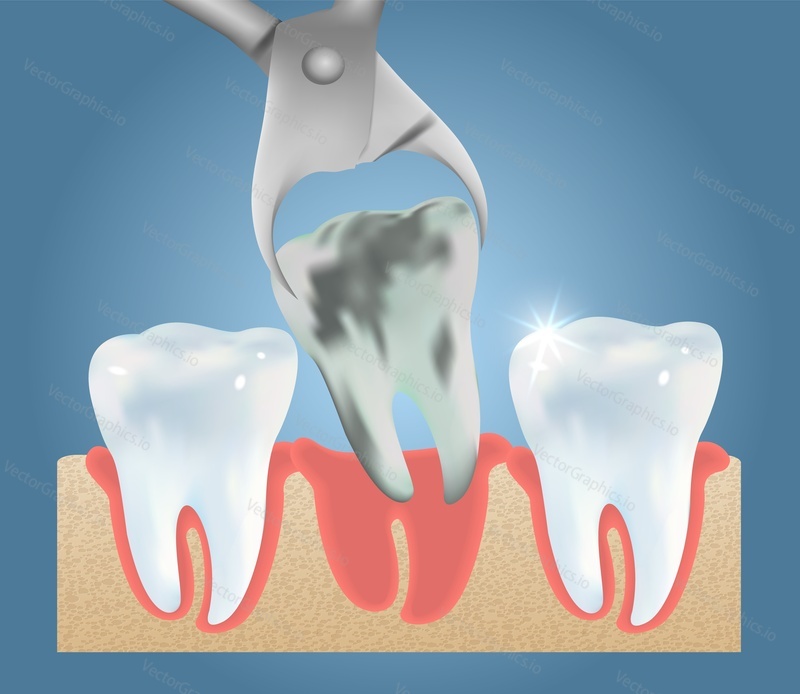 Tooth extraction vector medical education anatomy poster template. Tooth removal procedure, dental surgery concept.