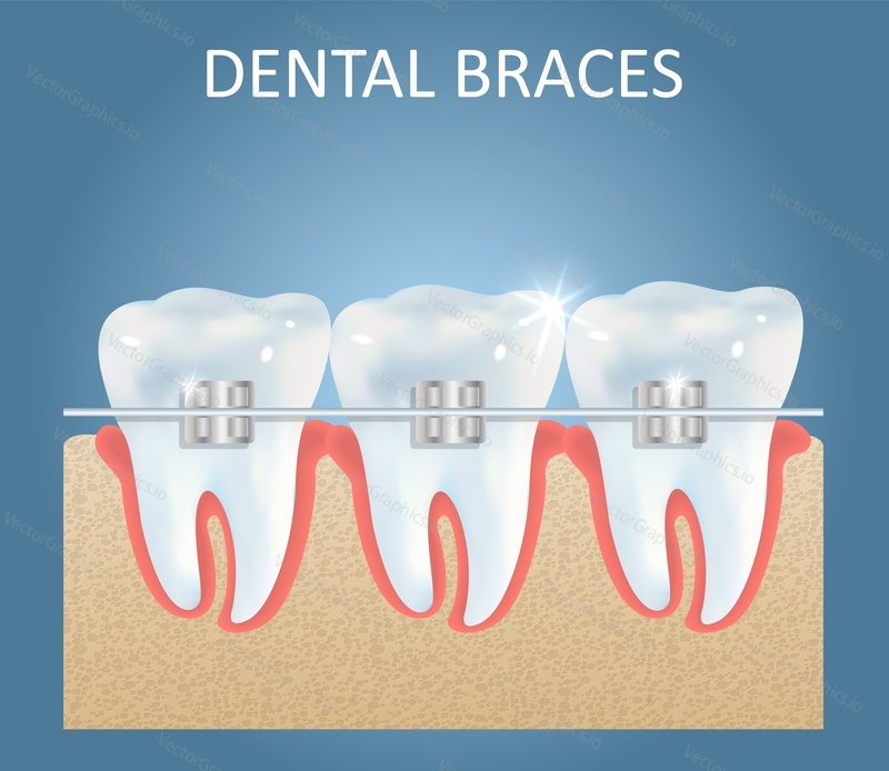 Dental braces vector medical education anatomy poster template. Realistic white teeth with brackets. Orthodontics, orthodontic treatment concept.