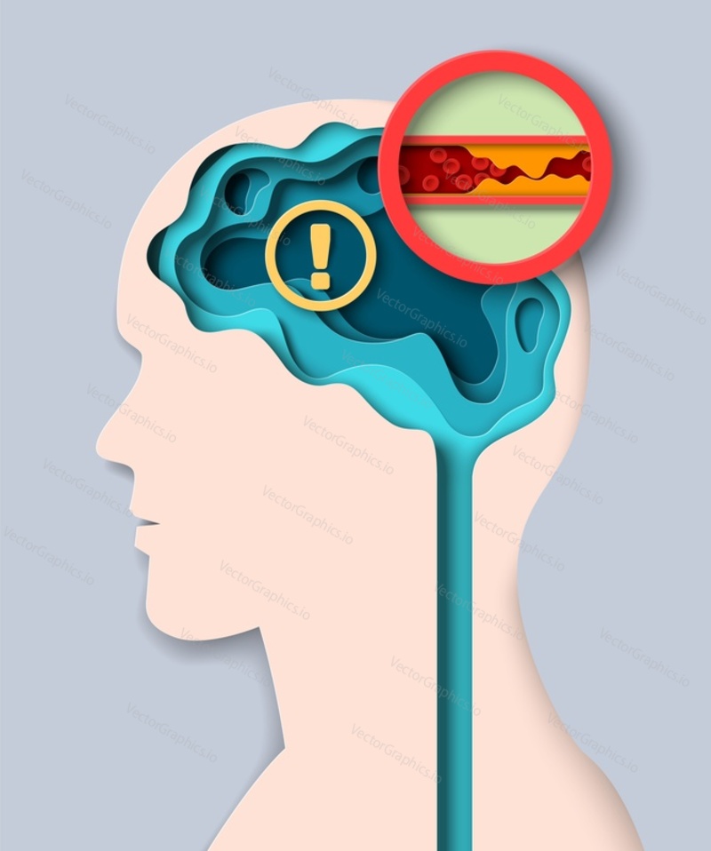 Brain stroke medical vector. Paper cut 3d illustration of human head with vessel clot. Cardiovascular disease prevention and treatment poster template. Medicine, health and neurology concept