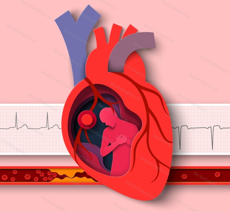 Heart attack paper cut vector. Cardiology disease medical poster. Anatomy of human cardiovascular organ abstract design and cardiogram, atherosclerotic vessel illustration