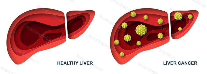 Liver cancer and healthy organ vector illustration. Disease complication. Carcinoma diagnosis and treatment. Medical poster or banner. Paper cut 3d art craft design