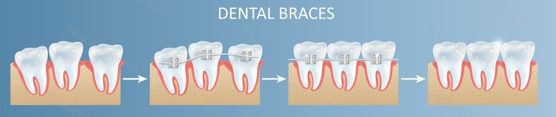 Dental teeth braces installation steps vector poster illustration. Dental medicine , stomatology and tooth treatment concept
