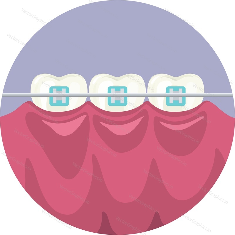 Tooth braces installation vector icon isolated on white background