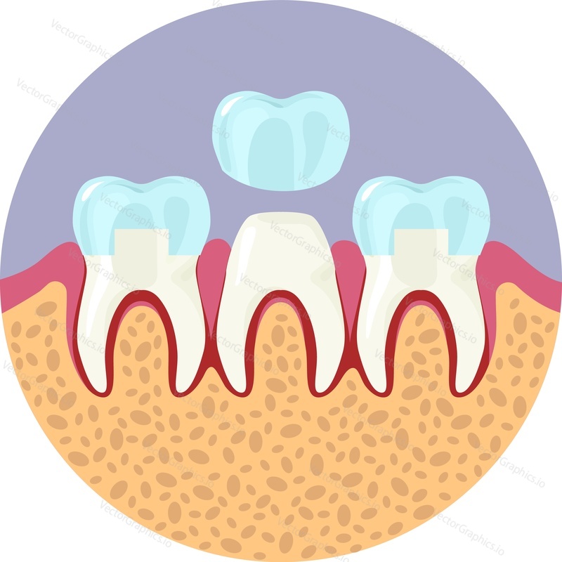 Tooth veneers installation vector icon isolated on white background