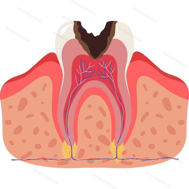 Sick destroyed tooth with rotting roots dental anatomy vector icon isolated on white background